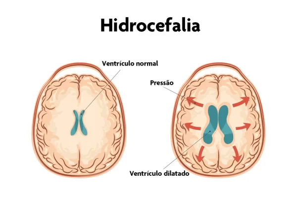 Saúde e Neurocirurgia: caso de Chico Buarque chama atenção para condição silenciosa que afeta idosos